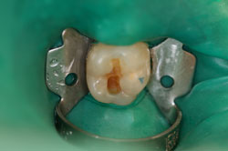 Large Decay in Dentine