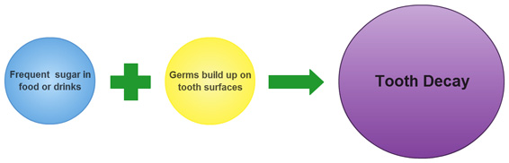 Dental Decay Diagram