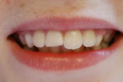 Tooth Fracture