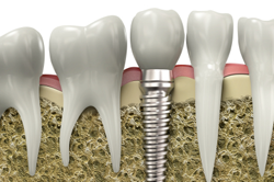 Single Implant