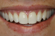 Healthy Gums